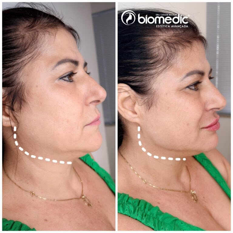 Contorno Facial e Preenchimento Labial