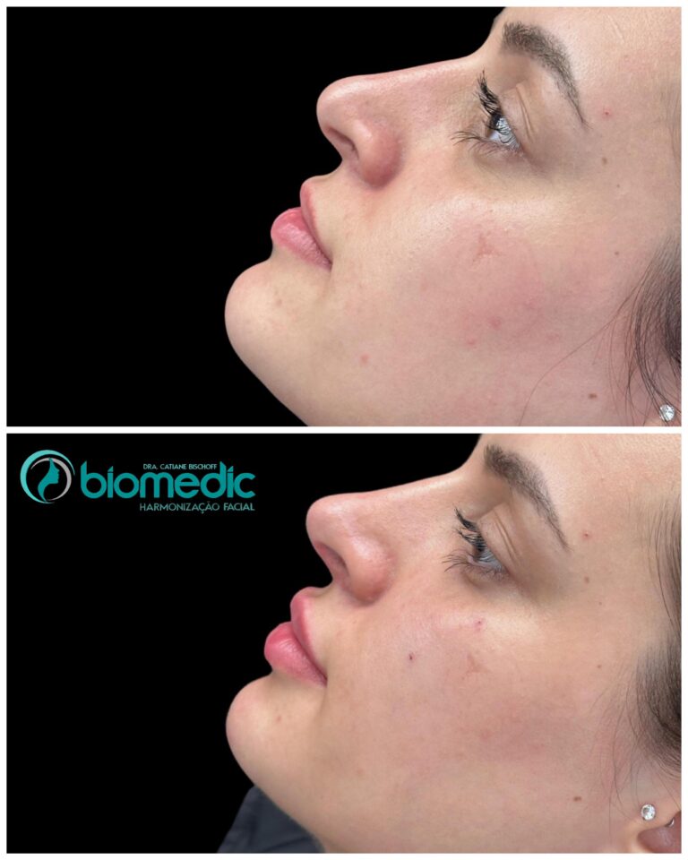 Mento (queixo), preenchimento labial, Rinomodelação, preenchimento olheiras