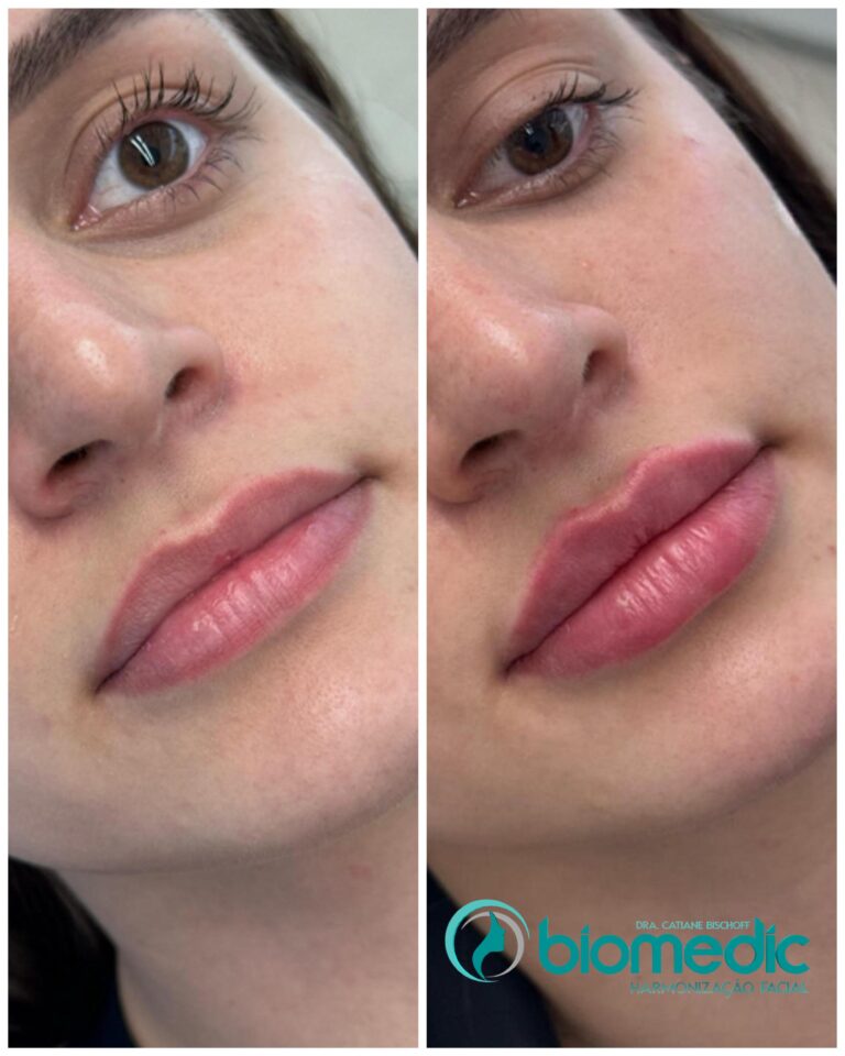 Preenchimento Labial