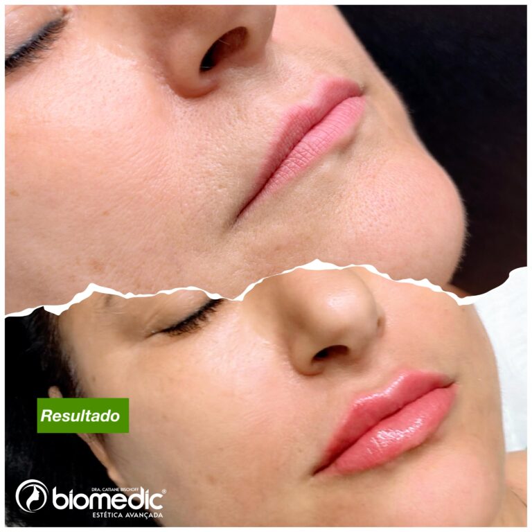 Preenchimento Labial