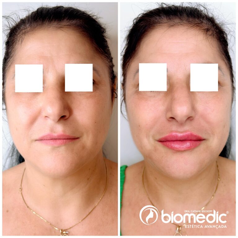 Preenchimento Labial