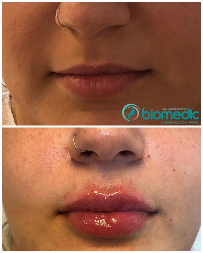 Preenchimento Labial